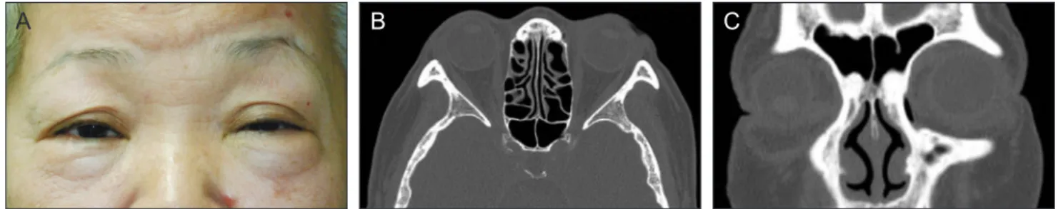 Fig. 2. Chest radiograph shows multiple confluent irregular opac- opac-ities (arrow) in right upper lobe