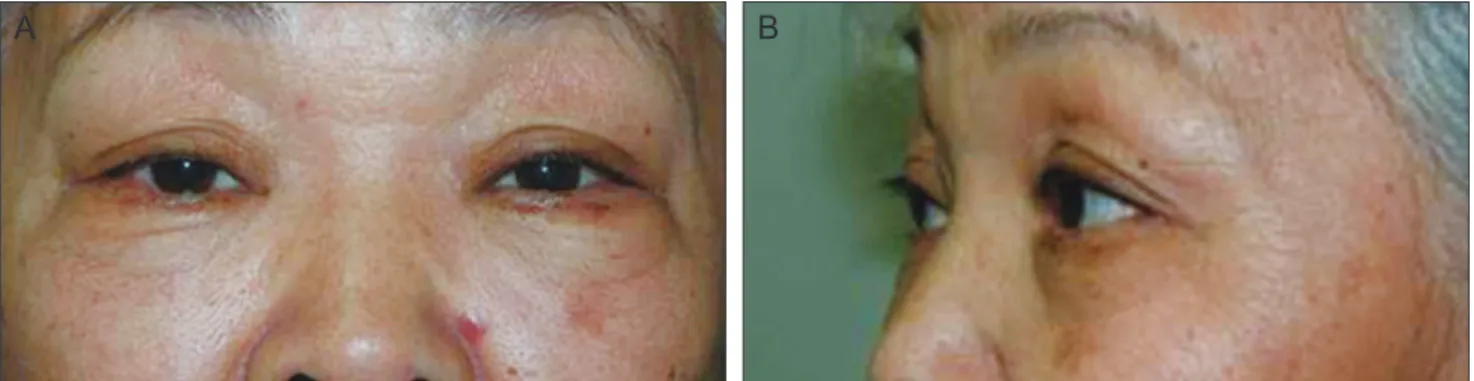 Fig. 4. (A) The patient showed significant improvement of the left lower lid swelling after surgery