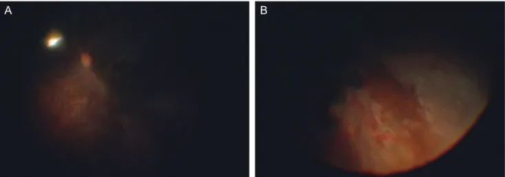 Fig. 1. Fundus photograph of left eye taken during pars plana vitrectomy. Note the retinal vascular obliteration (A) and inferotemporal  confluent necrotizing retinitis associated with retinal whitening (B)