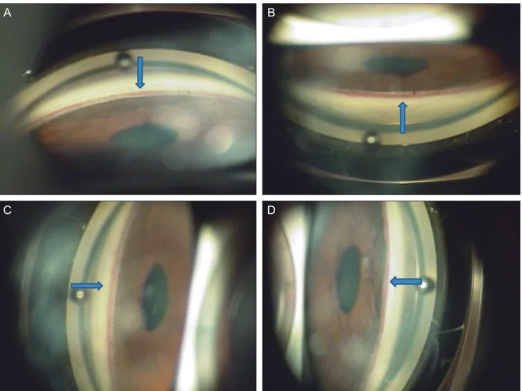 Fig. 1. Gonioscopic examination at initial examination showed 360 degree angle neovascularization (NVA) of the right eye