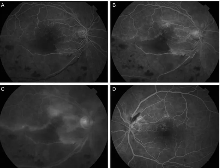 Fig. 3. Fluorescein angiography (FA) at initial visit. (A) In right eye, FA of the right eye showed significant delayed filling of the branches  of the inferior retinal artery in the ischemic area (30 seconds)