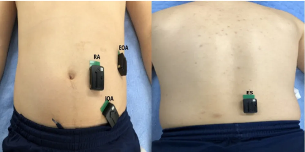 Fig. 2. Position of RA, EOA, IOA, and ES electrodes.