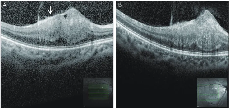 Fig. 2. Spectral-domain optical coherence tomography reveals an elevated hyperreflective mass in the retina with mild attenuation of the  retinal pigment epithelium and photoreceptor inner segment/outer segment junction