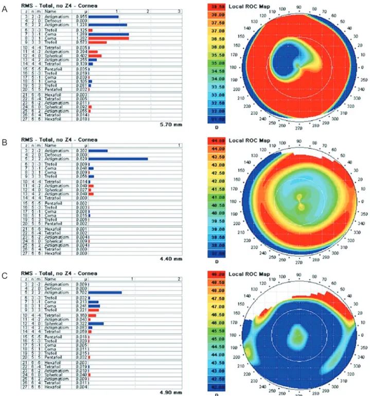 Fig. 2. Output of the iTrace aberrometer showing Zernike coefficients for the corneal wavefronts of patients who underwent three dif- dif-ferent kinds of surface ablation procedures