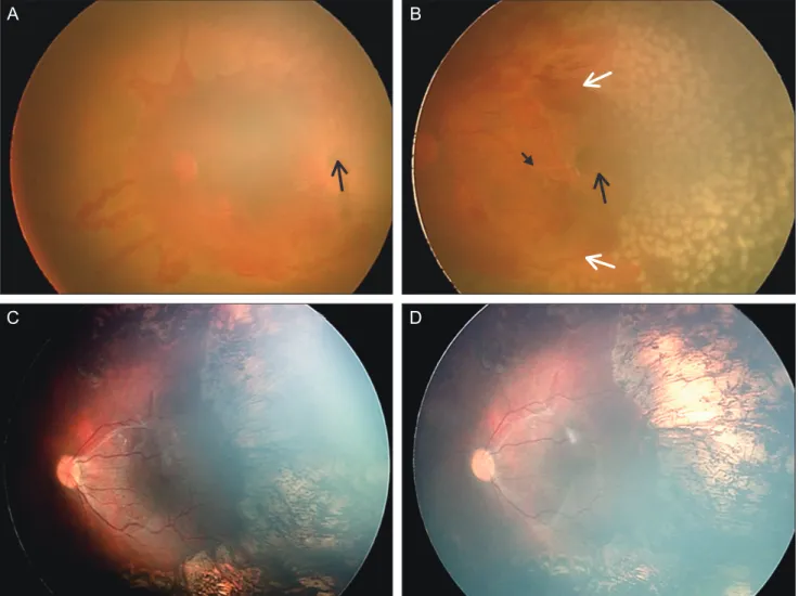 Fig. 3. Long-term clinical course of capillary-free zones demonstrated in the right eye of patient 5 (A) before laser treatment and (B) on  the day of laser treatment (post-treatment)