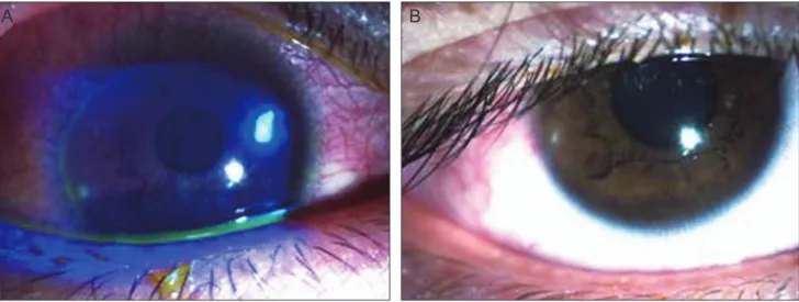 Fig. 1. (A) The slit-lamp photography at the first visit showed a 0.5 mm × 0.5 mm-sized round corneal epithelial defect, with stromal infil- infil-tration