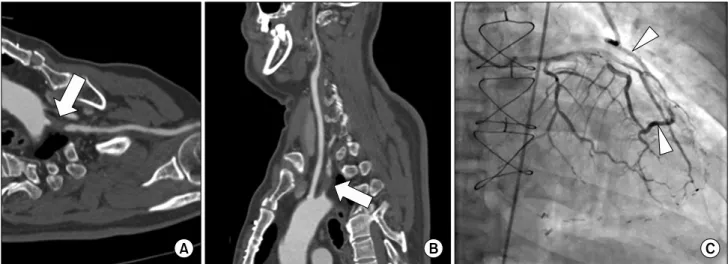 Fig. 1. (A, B) Preoperative computed tomographic angiography demonstrated near-total occlusion (arrow) at the ostium of the left sub- sub-clavian artery