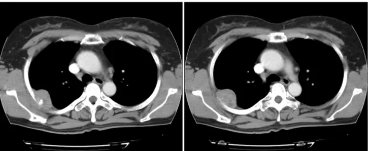 Fig. 1. Computed tomography of the chest shows a heterogeneous mass attached to the right parietal pleura with direct invasion of the  posterior arch of the right 4th rib.