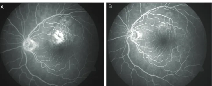 Fig. 2. (A) Mid-phase fluorescein angiogram of the left fundus showing the relatively well-delineated lesion above the fovea with patchy  areas of hyperfluorescence, before transpupillary thermotherapy