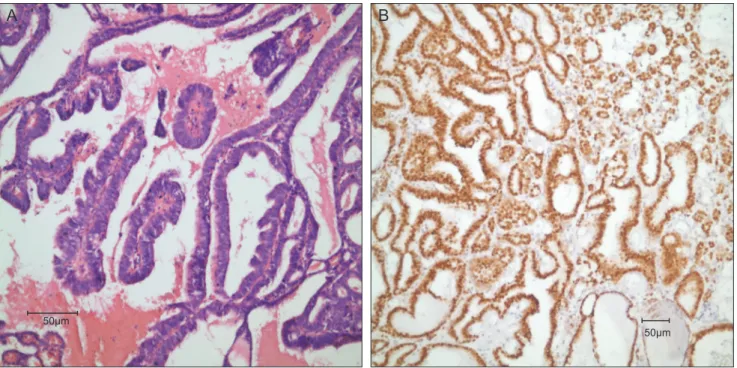 Fig. 3. Histopathological view of the specimen showing (A) papillary excrescences typical of papillary thyroid carcinoma (H&amp;E, ×40) and (B)  strong thyroid transcription factor 1 signals (×40)