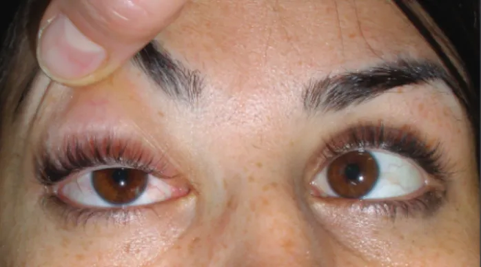 Fig. 2. The patient presented with paresis of the abducens nerve  in the right eye when looking to the right.