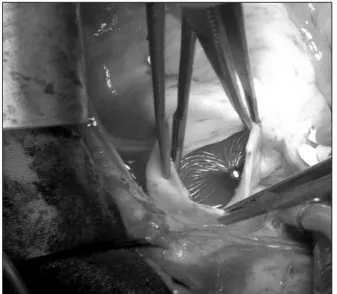 Fig. 2. View of the embolized device in the pulmonary artery  during surgery.