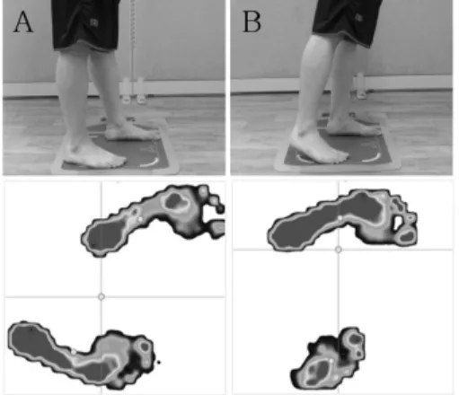 Fig 1. Evaluation of weight bearing ratio on  affected side. (A) Standing position on affected side forward step