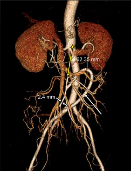 Fig. 2. Postoperative reconstructed computed tomography angiog- angiog-raphy showed the C-shaped polytetrafluoroethylene graft (white  ar-row) from the right common iliac artery to the superior mesenteric  artery (SMA) and good blood flow
