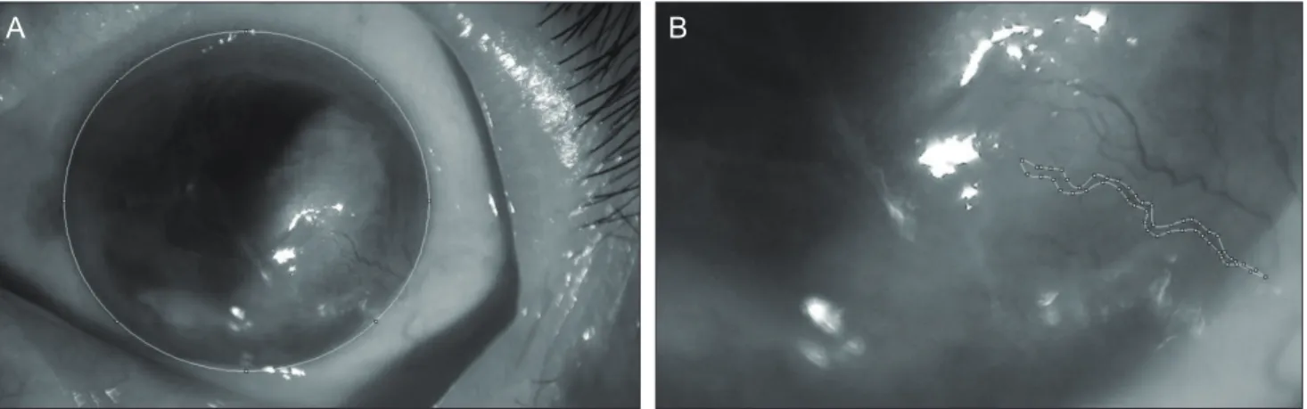 Fig. 1. The measurement of corneal neovascularization (NV) area using the Image J program