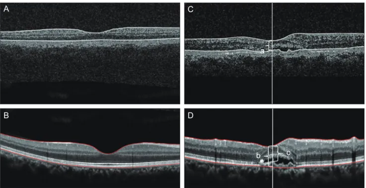 Fig. 1. Representative cross-sections taken by Stratus (A) and Spectralis (B) optical coherence tomography (OCT) in normal controls,  and the measurement of foveal thickness (FT) by Stratus OCT (C) and Spectralis OCT (D) in exudative age-related macular  d