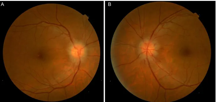 Fig. 2. Fluorescein angiography on the day of initial visit (A,C) and two weeks later (B,D)