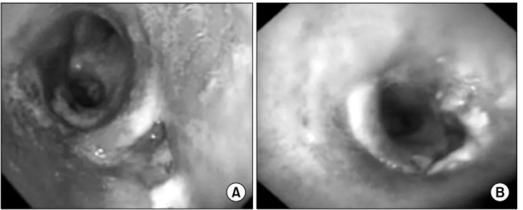 Fig. 2. (A) The left main bronchus  was ruptured and separated  pre-operatively in patient with blunt chest  trauma