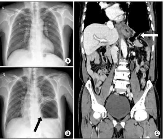 Fig. 1. The patient had a normal  chest X-ray four months earlier (A). 