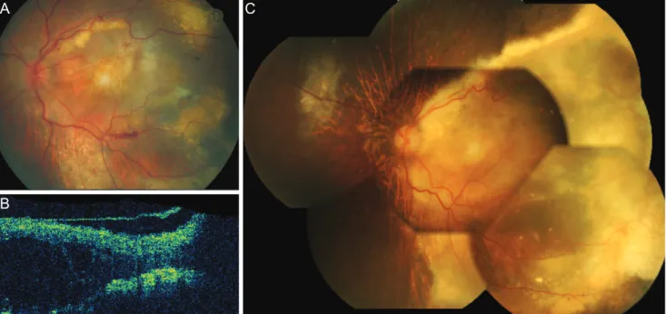 Fig. 3. A 78-year-old female diagnosed with occult choroidal neovascularization with extensive exudation (A, fundus photography; B,  optical coherence tomography)