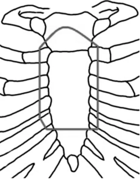 Fig. 2. Upper 2/3 of sternal body with lower half of manubrium  and 2nd through 5th intercostal rib cartilages at both sides were  resected.