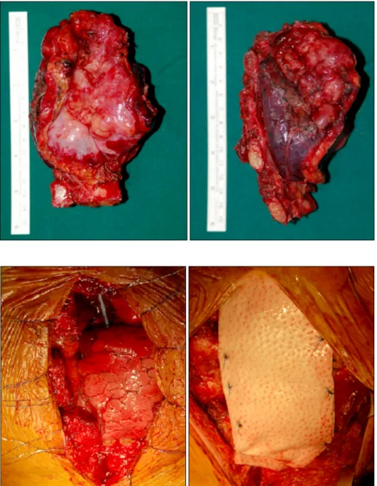 Fig. 3. Specimen consists of ster- ster-num, rib, sternal mass and wedge  resected lung.