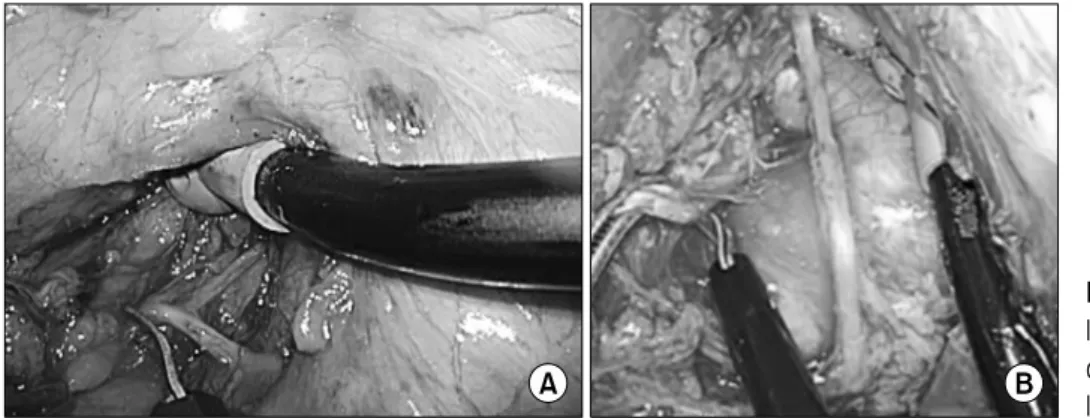 Fig. 3. Dissection of paratracheal  lymph nodes. (A) Along the right  re-current laryngeal nerve
