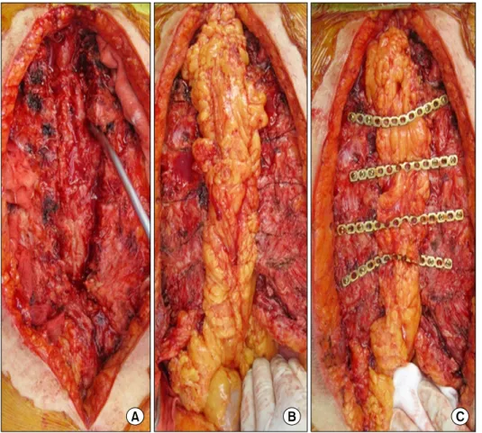 Fig. 2. Total sternectomy followed by omental flap interposition and titanium  plating (patient #13)