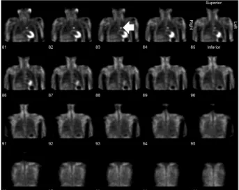 Fig. 2. Preoperative computed tomog- tomog-raphy (CT). Preoperative CT findings  show an ectopic parathyroid adenoma  about 1.5 cm located in the  aorto-pulmo-nary window, and it is suspected to be adhered to the aortic arch