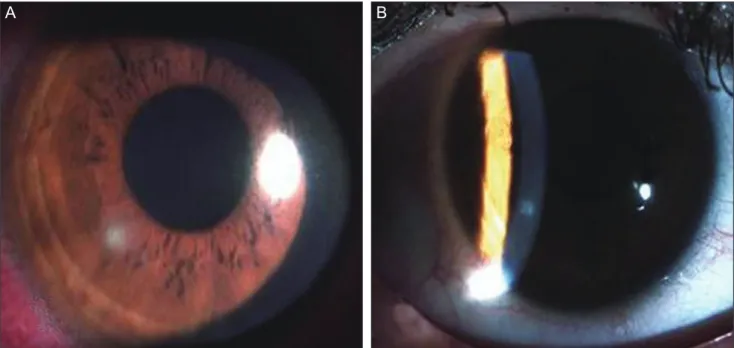 Fig. 3. (A)  Slit-lamp photography at the first visit showed a 0.5 × 0.5 mm-sized, round corneal epithelial defect with stromal infiltration  at the 7 o’clock direction