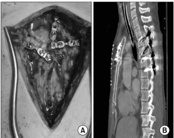 Fig. 2. (A) After the successful reduction, the sternum was rigidly  fixed with three 4-holed SternaLock straight-plates