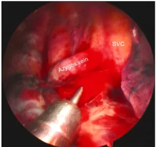 Fig. 2. A 5-mm endobiopsy aspiration needle was introduced into the  mass. SVC, superior vena cava.