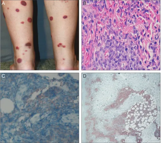 Fig.  2.  (A)  This  photograph  demonstrates  multiple   ery-thematous and violaceous,  well-defined, coin-sized plaques and  nodules in the lower limbs