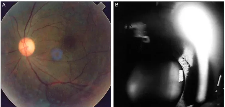 Fig. 3. (A) Vitreous opacity resolved after radiotherapy at 900 cGy. (B) The iris masses resolved after radiotherapy at 900 cGy.