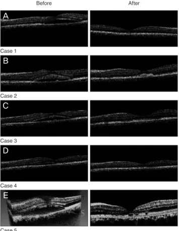 Fig. 1. OCT pictures of 4 cases before and after treatment by IVB  showing nearly complete (cases 1 [A], 2 [B], and 3 [C]) and partial  (cases 4 [D] and 5 [E]) resolutions of subretinal fluid.