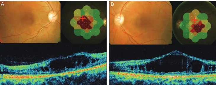 Fig. 3.  (A) The right eye color fundus shows macular schisis and diffuse retinal pigment epithelium (RPE) alterations