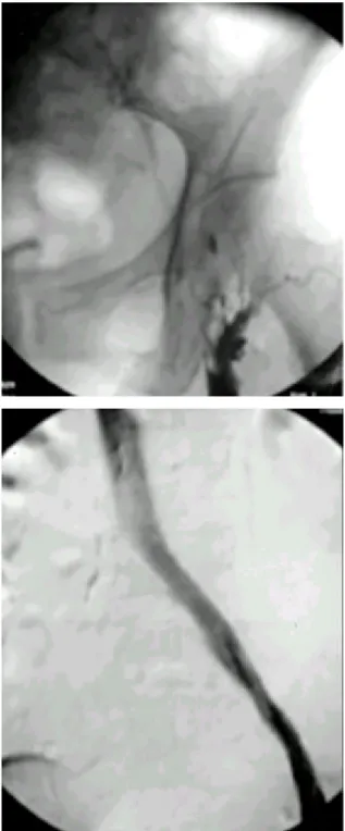 Fig . 1. 44- yea r- old woma n with a cute Dee p ve in thromfos is with s te nos is of left ilia c ve in(Ca s e 2).