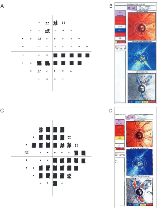 Fig. 2. Clinical example showing visual field (VF) data and scanning laser polarimetry (SLP) retinal nerve fiber layer (RNFL) informa- informa-tion in a 54-year old woman with glaucomatous eyes