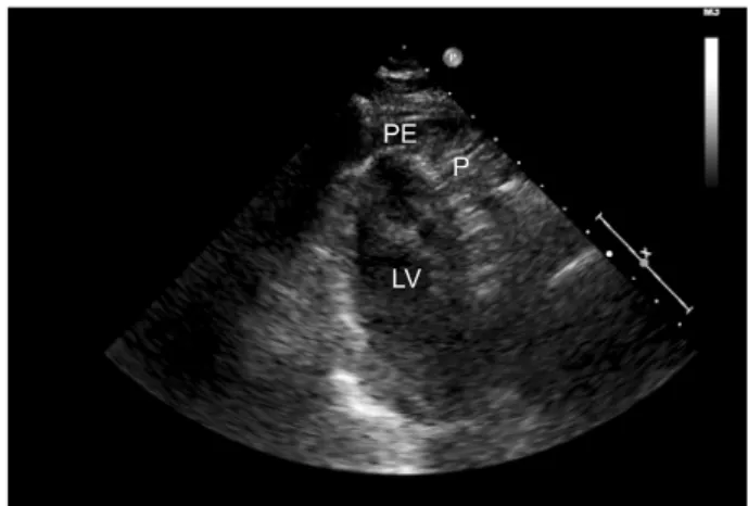 Fig. 1. The echocardiographic finding (apcial 2 chamber view) of  the patient 2 showing the psuedoaneurysm (P) of mid  antero-lateral wall of left ventricular (LV) wall with moderate amount  peri-cardial effusion (PE).
