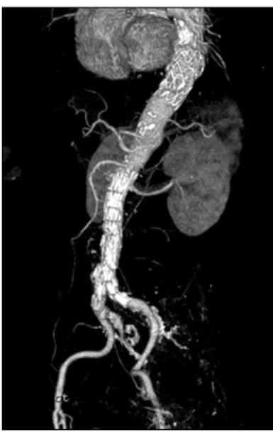 Fig. 2. During the first stage, a 34×100 mm stent-graft, a self-ex- self-ex-pandable custom-made type was deployed along the thoracic  saccular aneurysm