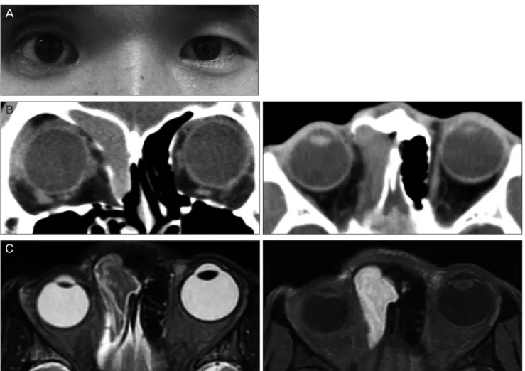 Fig. 1. (A) Preoperative view of a 27-year-old man with right frontoethmoidal mucocele