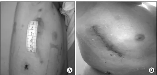 Fig. 1. (A, B) The postoperative im- im-age of a patient undergoing the right  vertical axillary minithoracotomy.