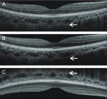 Fig. 1. Choroidal B-scan image without averaging in the conven- conven-tional method shows an obscure choroid/sclera junction (A)