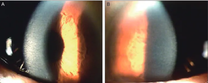 Fig. 2. Slit lamp photography of the patient’s mother. (A) Right eye. Corneal stroma with arcuate slit beam shows diffuse clouding in the  right eye