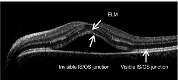 Fig. 1. Optical coherence tomography image of a 55-year-old  woman with central serous chorioretinopathy