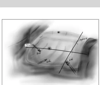 Fig. 1. Patient position for a total thoracoscopic ablation. MCL,  midclavicular line.