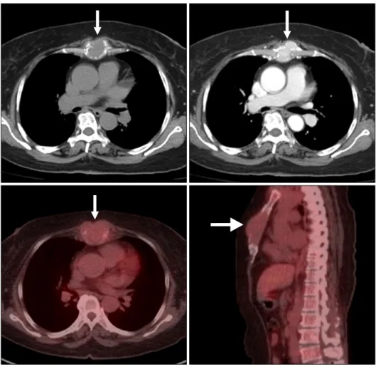 Fig. 1. Chest computed tomography  (CT) and positron emission  tomog-raphy-CT scans of a sternal bulging  mass