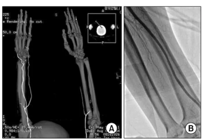 Fig. 1. A computed tomography scan (A) shows an obstruction of  the brachial artery. After thrombectomy, the brachial artery shows  good blood flow in peripheral angiography (B).