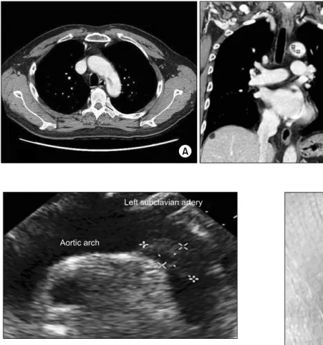 Fig. 2. A computed tomography  scan ([A] transverse section, [B]  co-ronal section) shows a mass lesion  (3.0×1.5 cm) in the aortic arch