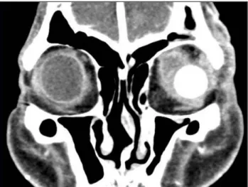 Fig. 4. A positron emission tomography image revealed the multiple  intense hypermetabolic foci on the left orbit and the skull as well as  along the spine